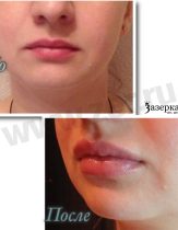 Контурная пластика губ, препарат Juvederm Ultra 3 1ml. Работа врача-косметолога Даниловой Яны Евгеньевны